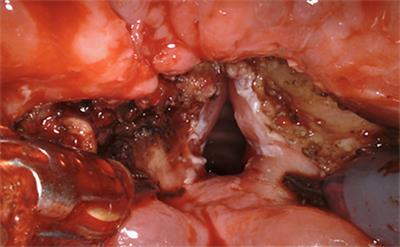 A Contemporary Review of Evidence for Transoral Robotic Surgery in Laryngeal Cancer